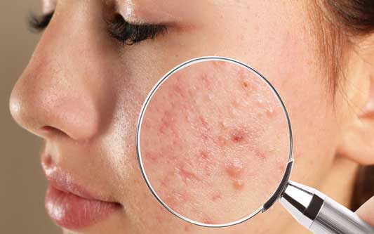 le magnétiseur contre-l'acné