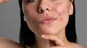 séance de magnétisme contre l'acné.
