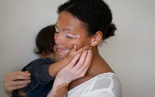 Le magnétiseur contre le vitiligo.